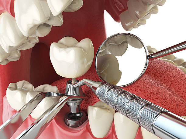 Best Emergency Denture Repair in Apollo Beach, FL